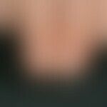 Diffuse whitish keratinization disorders of both thumbnails in an 8-year-old girl of Turkish orig...