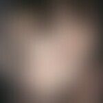 Alopecia areata. roundish, centrifugally and medially spreading, smooth, hairless areas with pres...