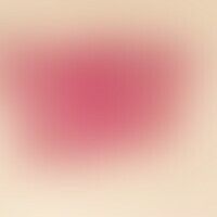 Angioleiomyom. Scharf zur U... Angioleiomyom. Scharf zur Umgebung abgesetzter Tumor im mittleren und tiefen Korium; deutliche Eo...