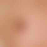 angioma, senile. 7 mm large lump on the cheek of a 70-year-old patient, existing for years, reddi...