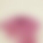 Angioma, senile. Convolute capillary vascular clusters in the upper corium. Epidermis above the v...