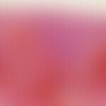 Angioma, senile. detail enlargement; slight irregular acanthosis of the epithelium; orthokeratosi...