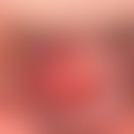 Balanoposthitis plasmacellularis, monocntric, therapy-resistant, little itching and burning, shar...