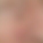 Basalzellkarzinom, knotiges. 72-jährige Patientin. Solitärer, chronisch dynamischer, seit 2 Jahre...