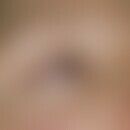 Blepharitis erythematosa. Rötung der freien Lidränder bei einer 33-jährigen Frau mit multipler Sk...