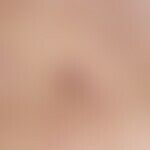 Narbe. Atrophische Narben bei Acne vulgaris. 16 Jahre alter Patient mit jetzt in Abheilung begrif...