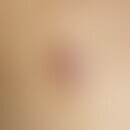 Coccidioidomycose. Detailvergrößerung: Schmerzloser, deutlich das Hautniveau überragender, braun-...