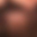 Büschelhaare:Folliculitis decalvans. Im Zentrum spiegelnde Narbenplatte mit dochtartigen Haarbüsc...