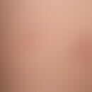 Brucellosis. One month after a vacation on a farm, occurrence of several acute, pinhead-sized red...