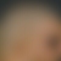 Cutis verticis gyrata. Seit... Cutis verticis gyrata. Seitliches Profil des Kapillitiums eines 26-jährigen Patienten (Bodybuilde...