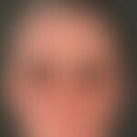 Dermatitis chronische aktinische (Typ lichtprovoziertes atopisches Ekzem). Übersichtsaufnahme: Di...