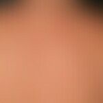 Dermatose, akute febrile neutrophile. Im Anschluss an hohes Fieber am Rücken eines 52-jährigen Ma...