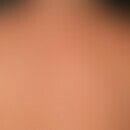 Dermatose, akute febrile neutrophile. Im Anschluss an hohes Fieber am Rücken eines 52-jährigen Ma...