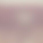 eczema, contact eczema, allergic. finding of spongiotic dermatitis with intraepithelial spongioti...