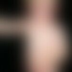 Dermatitis, atopische (nummuläre atopische Dermatitis): seit dem 1. Lebensmonat persistierender B...