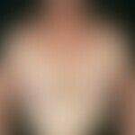 Intrinische atopische Dermatitis: Exazerbiertes Krankheitsbild mit multiplen, chronisch dynamisch...