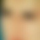 Dysplasie, anhidrotische ektodermale. Ichthyosiforme Hautveränderungen im Gesicht, Fehlen der Haa...