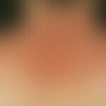 Eczema, photoallergic. seti 6 weeks of unpleasantly itchy and exciting skin lesions. these occurr...