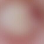 Epidermalzyste: Auflichtmikroskopie: Scharf begrenzter, verschieblicher, runder Knoten. Am untere...