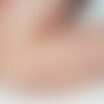 Acrodermatitis papulosa eruptiva infantilis: Disseminated seeding of inflammatory papules on the ...