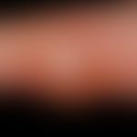 Abszess nach Insektenstich
