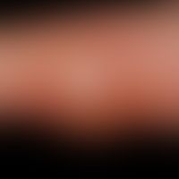 Abszess nach Insektenstich
Abszess nach Insektenstich