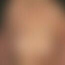 Acanthosis nigricans maligna. Generalisierter Befall mit hyperkeratotischen, teils exkoriierten P...