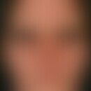 Follikulitis, gramnegative. Im Bereich der Gesichtshaut lokalisierte, disseminiert stehende, soli...