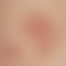 Erythema necroticans migrans: Coarse lamellar scaling erythema with marginal pustules in glucagon...
