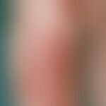 erythema nodosum. multiple, blurred, very pressure painful, doughy, slightly raised, reddish-livi...
