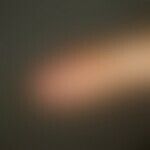 Glomus tumor, frequent, discreet finding with blue-reddish, very pressure-painful discoloration o...