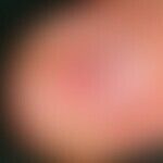Glomus tumor. solitary, painful, reddish discoloration under the nail of the right ring finger in...