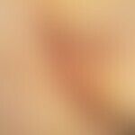 Hidradenitis suppurativa. chronic scarring stage, infiltrated intergrown strands and abscesses in...