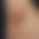 Hidradenitis suppurativa: chronisch persistierende, bräunlich oder rötlich livide Vernarbungen in...