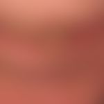 Carcinoma, carcinoma of the lip (spinocellular carcinoma of the lower lip, existing for years) Sm...