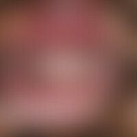 Hyperpigmentierung, postinf... Hyperpigmentierung, postinflammatorische. Nach Zahnfleischentzündung akut aufgetretene, asymptoma...
