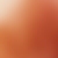 Hyperpigmentierung, postinf... Hyperpigmentierung, postinflammatorische. Auflichtmikroskopie: Diffuse, interfollikuläre, grau-br...