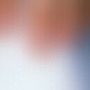Leukonychia: White coloration of the nail plate running in horizontal stripes in a 20-year-old wo...