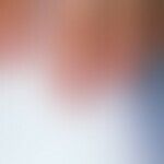 Leukonychie: In Querstreifen verlaufende Weißfärbungen der Nagelplatte bei einer 20-jährigen Frau...