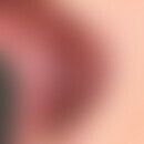 Oral leukoplakia: flat leukoplakia in the cheek area in heavy smokers; histological: precancerosi...