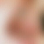 Lichen planus: Whitish, swollen, bizarrely configured, painless plaques on the cheek mucosa.
