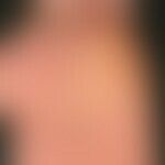 Lichen planus (classic type): itchy, polygonal, partially confluent, brownish-reddish papules on ...