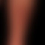 Lichen planus verrucosus, a hypertrophic lichen planus with pseudoepitheliomatous epithelial hype...