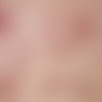 Lichen planus exanthematicu... Lichen planus exanthematicus. 32-year-old patient with this clinical picture, which developed wit...