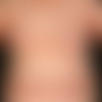 Lichen planus exanthematicu... Lichen planus exanthematicus. symmetricgeneralized distribution pattern of Lichen planus. the den...