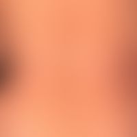 Lichen planus exanthematicu... Lichen planus exanthematicus: for 3 months persistent, itchy, generalized, dense rash with emphas...