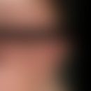 Keratosis Pilaris (follicularis): follikelgebundene Hornpapeln an Wangen, Augenbrauen und Extremi...