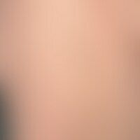 Keratosis pilaris (follicul... Keratosis pilaris (follicularis): Komedonen-artige, follikulär gebundene Papeln im Bereich des Ob...