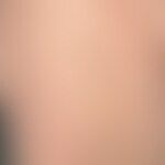 Komedonen-artige Keratosis follicularis (s. dort):  im Gegensatz zu klassischen Komedonen fehlt b...