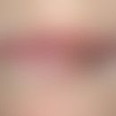 Lippenkarzinom : Breit aufsitzende, feste, schmerzlose, warzenartige, derb induriergte, erodierte...
